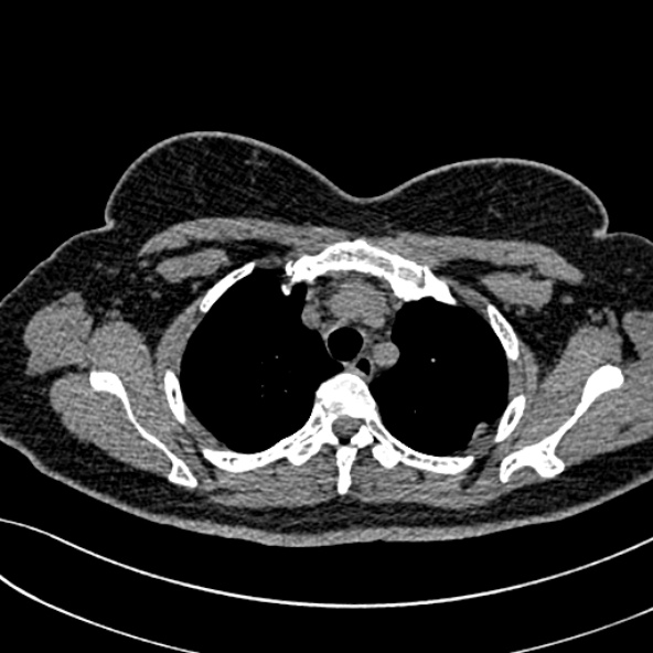 Normal CT chest- adult female (Radiopaedia 52522-58428 Axial non-contrast 32).jpg