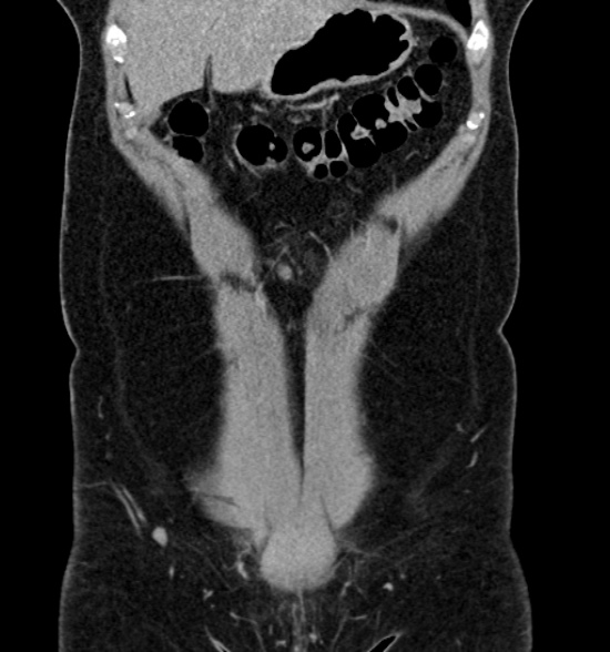 Normal CT intravenous urogram (Radiopaedia 39444-41759 A 189).jpg