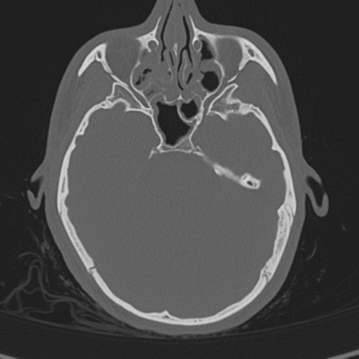 Normal CT skull (Radiopaedia 40798-43459 A 50).png