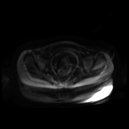 Normal MRI abdomen in pregnancy (Radiopaedia 88001-104541 Axial DWI 88).jpg