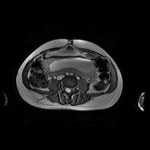 File:Normal MRI abdomen in pregnancy (Radiopaedia 88001-104541 Axial Gradient Echo 31).jpg