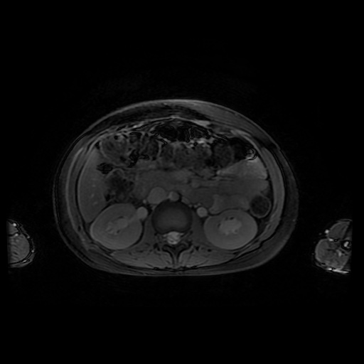 File:Normal MRI abdomen in pregnancy (Radiopaedia 88001-104541 D 23).jpg