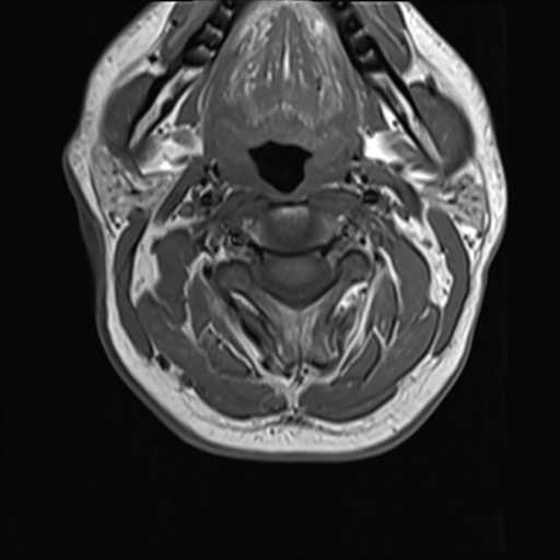 File:Normal MRI cervical spine (infection protocol) (Radiopaedia 53916-60039 Axial 17).png