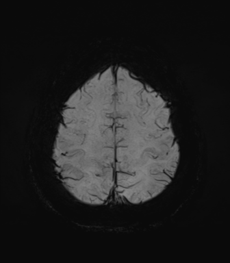 Normal MRI internal auditory canal (Radiopaedia 41613-44525 Axial SWI MIP 67).png