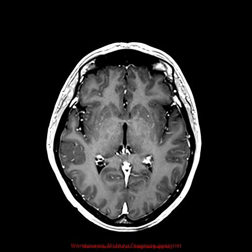 Normal adult brain MRI (non-enhanced and contrast-enhanced) (Radiopaedia 75262-86379 Axial T1 C+ 103).jpg