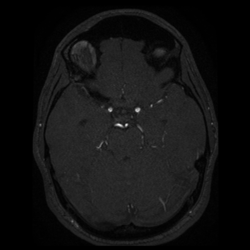 Normal brain MRA (Radiopaedia 41046-43793 Axial MRA 59).png