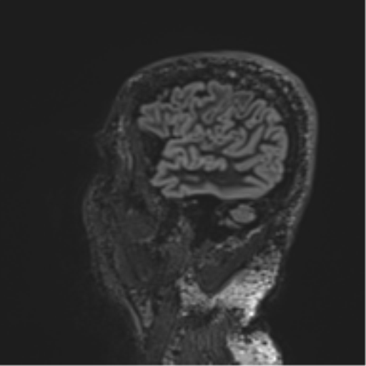 Normal brain MRI (non-focal epilepsy protocol) (Radiopaedia 53917-60040 Sagittal DIR 52).png