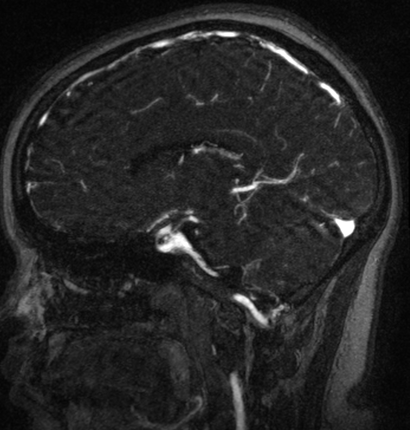 Normal brain MRI and venogram (Radiopaedia 39554-41862 Sagittal MRV 29).jpg