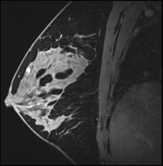 Normal breast MRI - dense breasts (Radiopaedia 80454-93850 I 107).jpg