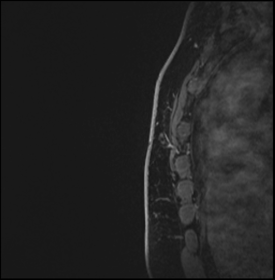 Normal breast MRI - dense breasts (Radiopaedia 80454-93850 I 173).jpg