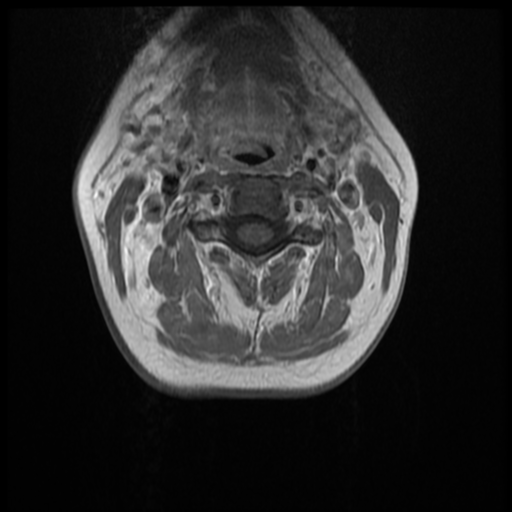 File:Normal cervical and thoracic spine MRI (Radiopaedia 35630-37156 Axial T1 C+ 23).png