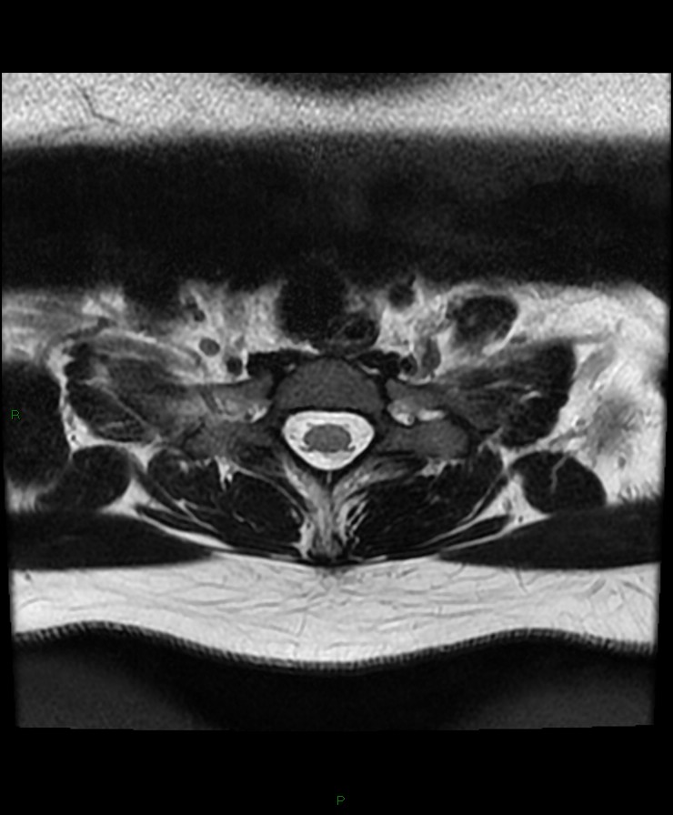 Normal cervical spine MRI (Radiopaedia 80146-93454 Axial T2 94).jpg