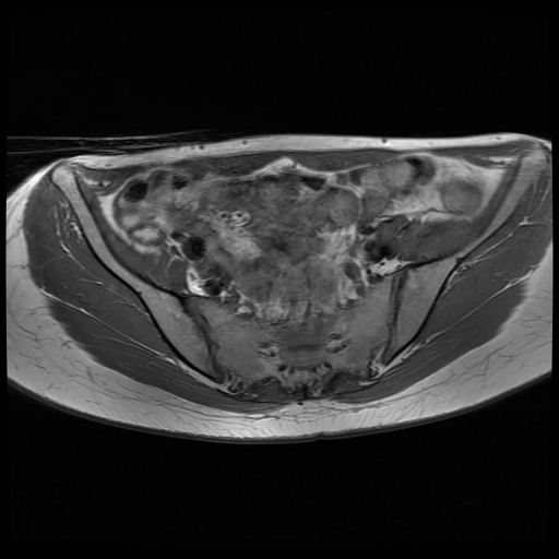 File:Normal female pelvis MRI (retroverted uterus) (Radiopaedia 61832-69933 Axial T1 11).jpg
