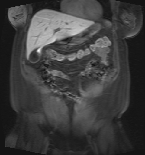 File:Normal hepatobiliary phase liver MRI (Radiopaedia 58968-66230 B 38).jpg
