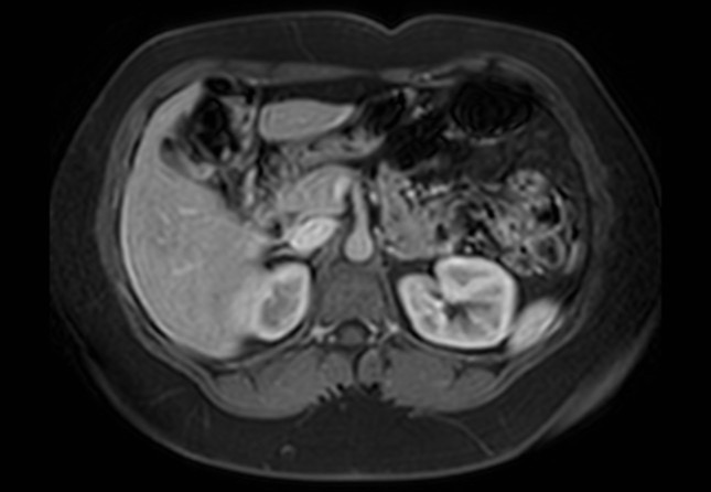 Normal liver MRI with Gadolinium (Radiopaedia 58913-66163 J 34).jpg