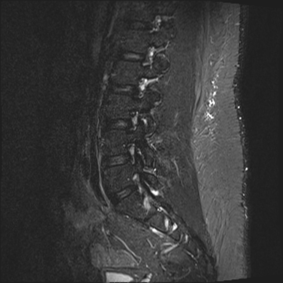 File:Normal lumbar spine MRI (Radiopaedia 47857-52609 Sagittal STIR 6).jpg