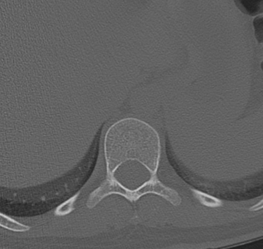 File:Normal lumbosacral CT (Radiopaedia 37923-39867 Axial bone window 3).png