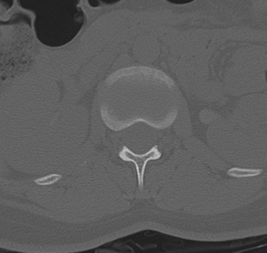 File:Normal lumbosacral CT (Radiopaedia 37923-39867 Axial bone window 34).png