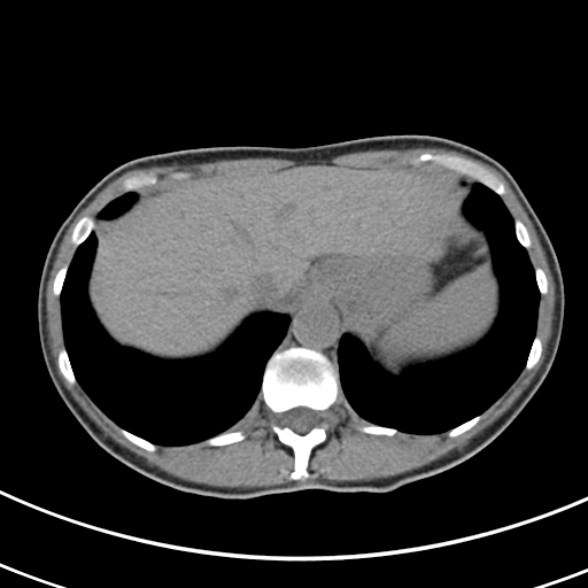 File:Normal multiphase CT liver (Radiopaedia 38026-39996 Axial non-contrast 9).jpg