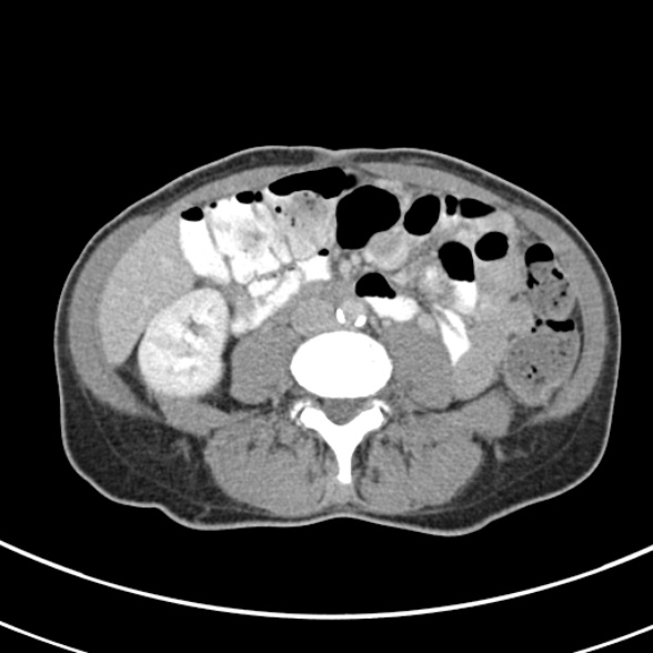 File:Normal multiphase CT liver (Radiopaedia 38026-39996 C 50).jpg