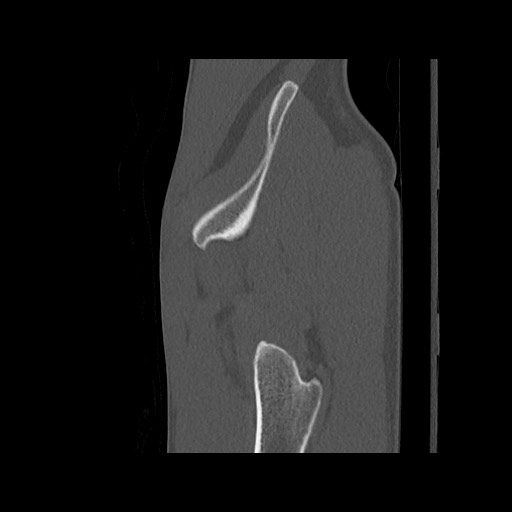 Normal pelvis (Radiopaedia 51473-57238 Sagittal bone window 128).jpg