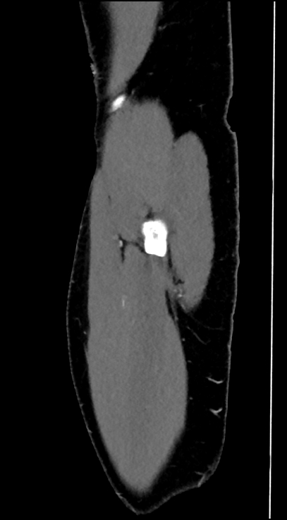 Normal pelvis CT angiogram (Radiopaedia 84966-100481 C 104).jpg