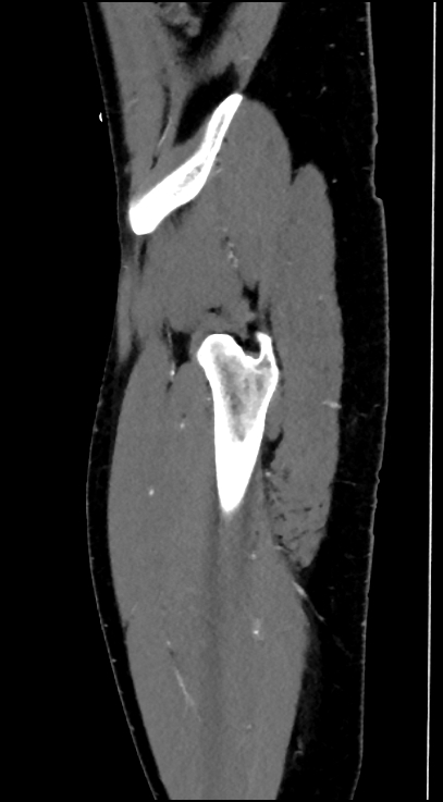 Normal pelvis CT angiogram (Radiopaedia 84966-100481 C 96).jpg