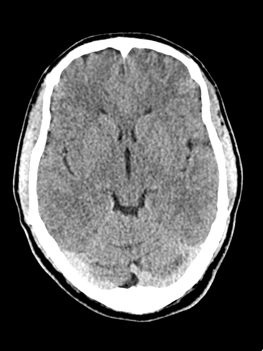 Normal trauma protocol brain and C-spine CT (Radiopaedia 83302-97709 Axial non-contrast 43).jpg