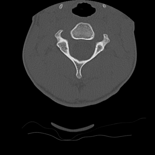 File:Normal trauma spine imaging (age 16) (Radiopaedia 45335-49358 Axial bone window 22).jpg