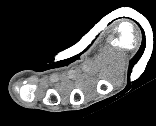 Normal wrist CT (Radiopaedia 41425-44297 Axial non-contrast 10).png