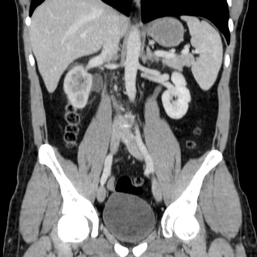 File:Obstructing ureteric calculus (Radiopaedia 18615-18514 C 42).jpg