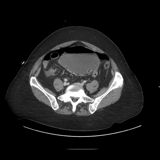 Obstructive distal colonic adenocarcinoma causing cecal perforation (Radiopaedia 86830-102989 A 140).jpg