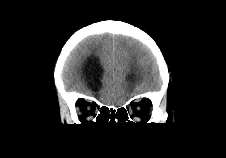 File:Obstructive hydrocephalus (Radiopaedia 30453-31119 Coronal non-contrast 10).jpg