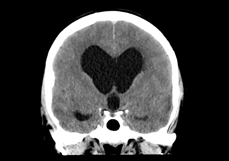 File:Obstructive hydrocephalus (Radiopaedia 30453-31119 Coronal non-contrast 17).jpg