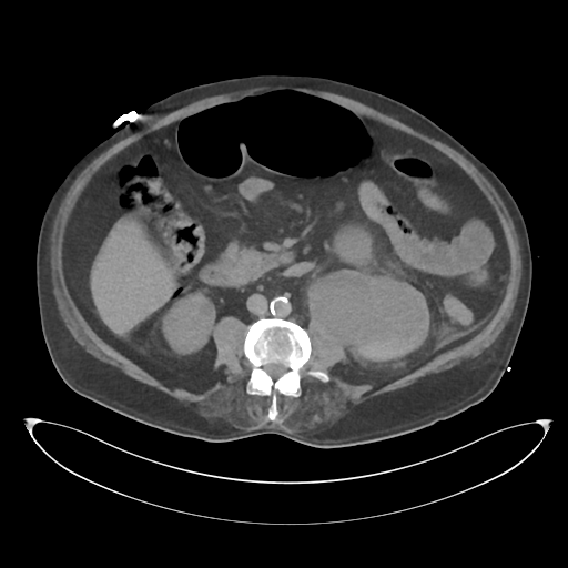 File:Obstructive pyelonephritis (Radiopaedia 46411-50844 Axial non-contrast 40).png