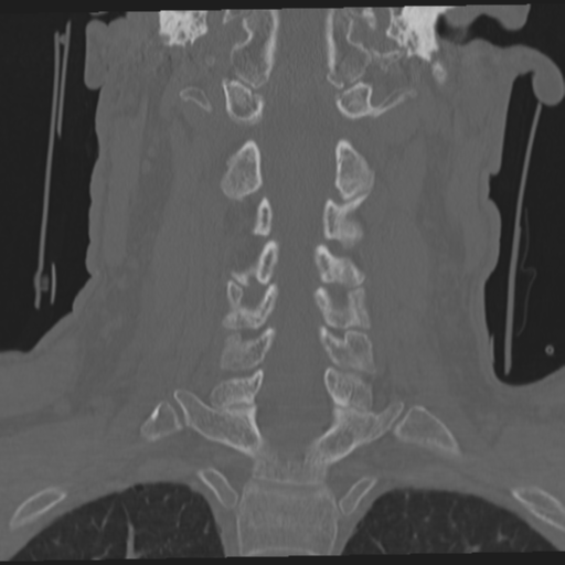 File:Occipital condyle fracture (Radiopaedia 33467-34517 Coronal bone window 36).png