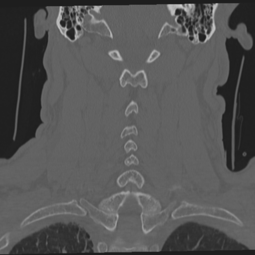 File:Occipital condyle fracture (Radiopaedia 33467-34517 Coronal bone window 44).png