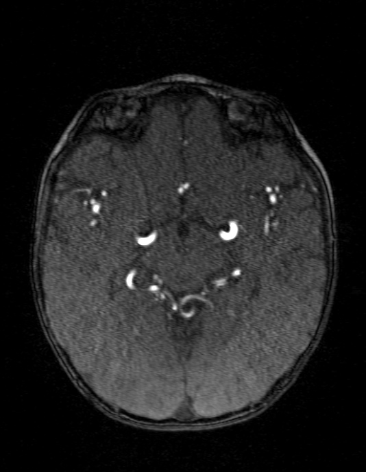 Occipital horn syndrome (Radiopaedia 14255-14129 MRA 73).jpg
