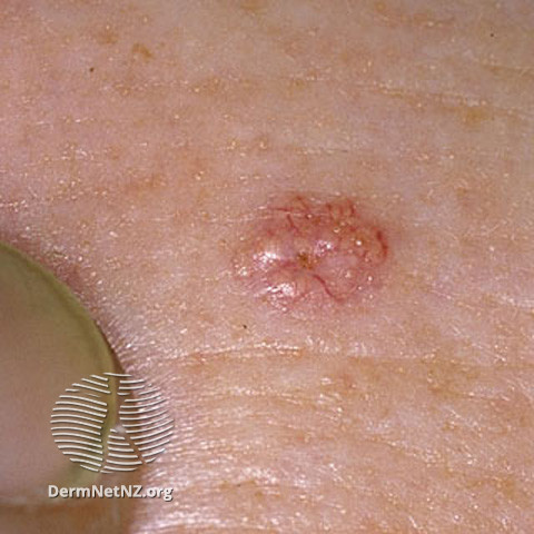 File:Sebaceous hyperplasia (DermNet NZ vascular-s-telangiectases-13).jpg