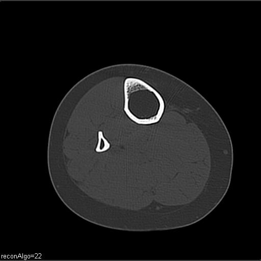File:ACL avulsion fracture (Radiopaedia 33833-34994 Axial bone window 33).jpg