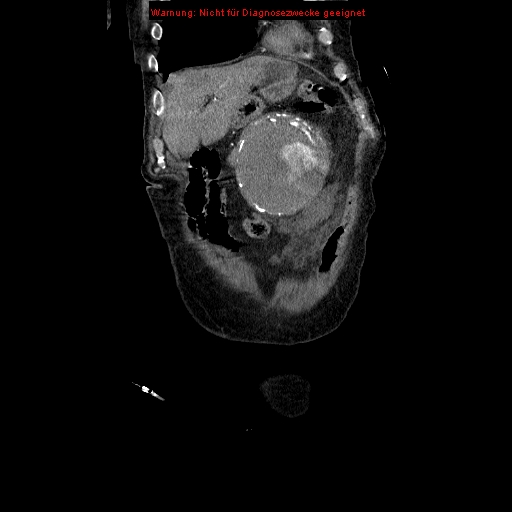 Abdominal aortic aneurysm- extremely large, ruptured (Radiopaedia 19882-19921 Coronal C+ arterial phase 20).jpg
