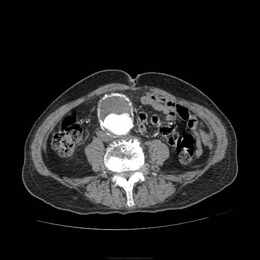 Abdominal aortic aneurysm (Radiopaedia 13341-13340 Axial C+ arterial phase 132).jpg
