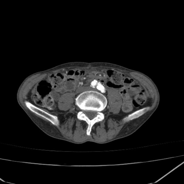 Abdominal aortic aneurysm (Radiopaedia 23703-23856 Axial C+ arterial phase 57).jpg