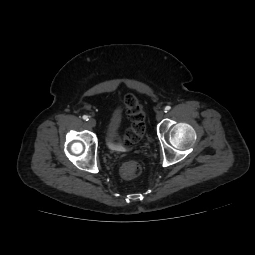 File:Abdominal aortic aneurysm (Radiopaedia 57318-64259 Axial C+ arterial phase 69).jpg