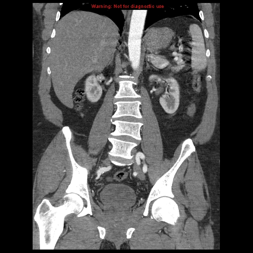 Abdominal aortic aneurysm (Radiopaedia 8190-9038 Coronal C+ arterial phase 78).jpg