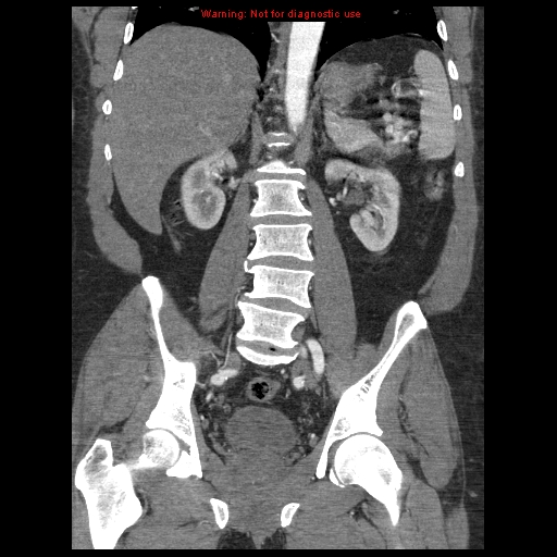Abdominal aortic aneurysm (Radiopaedia 8190-9038 Coronal C+ arterial phase 80).jpg