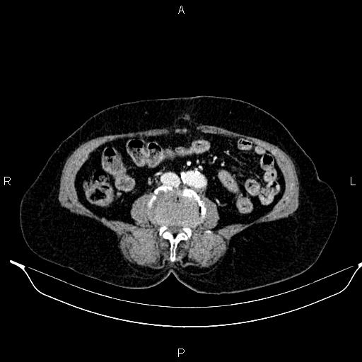 File:Abdominal aortic aneurysm (Radiopaedia 85063-100606 Axial C+ portal venous phase 45).jpg