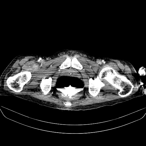 File:Abdominal collection due to previous cecal perforation (Radiopaedia 80831-94320 Axial C+ portal venous phase 210).jpg