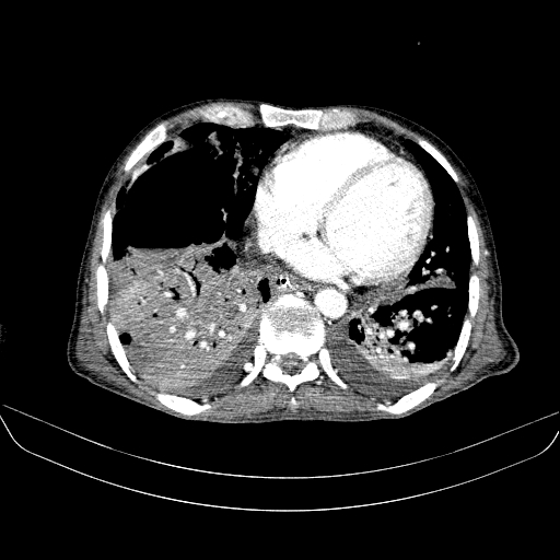 File:Abdominal collection due to previous cecal perforation (Radiopaedia 80831-94320 Axial C+ portal venous phase 4).jpg