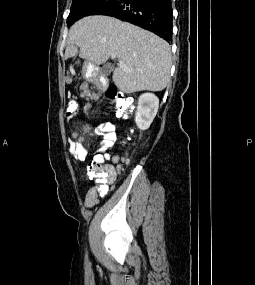 File:Abdominal lymphoma with sandwich sign (Radiopaedia 84378-99704 Sagittal C+ portal venous phase 17).jpg
